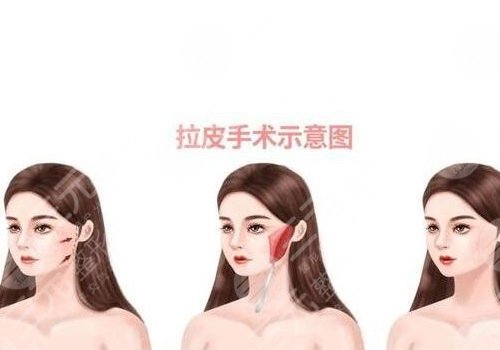 拉皮手術(shù)多大年齡做合適？