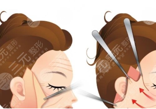 拉皮手術(shù)多大年齡做合適？