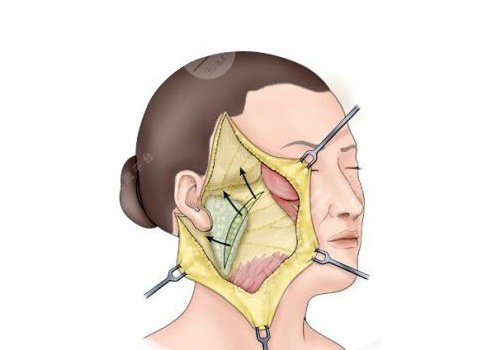 拉皮手術(shù)多大年齡做合適？
