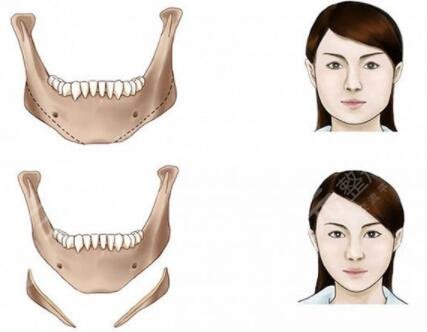 下頜角整形手術(shù)