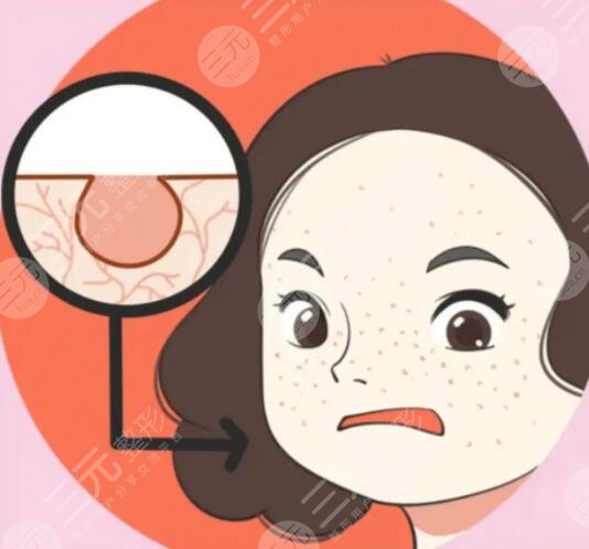 怎樣收縮臉部毛孔粗大的方法，光子嫩膚是好的項目選擇！