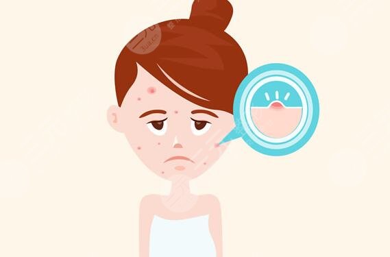 祛痘如何護(hù)理?