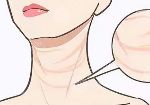 頸紋填充能維持多久呢？色素沉著能消退嗎？