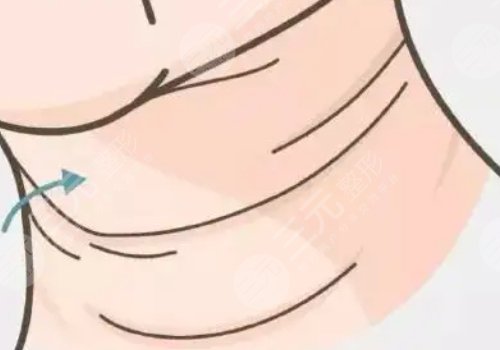 頸紋填充能維持多久呢？色素沉著能消退嗎？