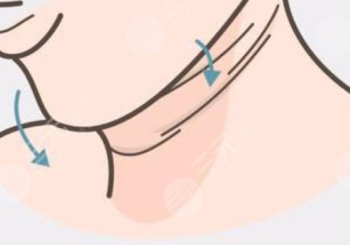 頸紋填充能維持多久呢？色素沉著能消退嗎？