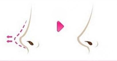 膨體隆鼻如何護理?