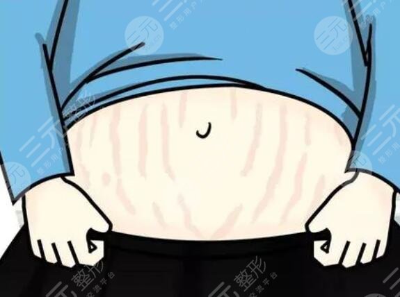 5個(gè)妙招幫助消除妊娠紋