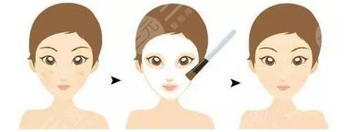 果酸換膚注意的事項(xiàng)有哪些?