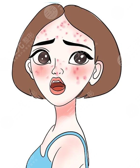 生長痘痘如何護理?