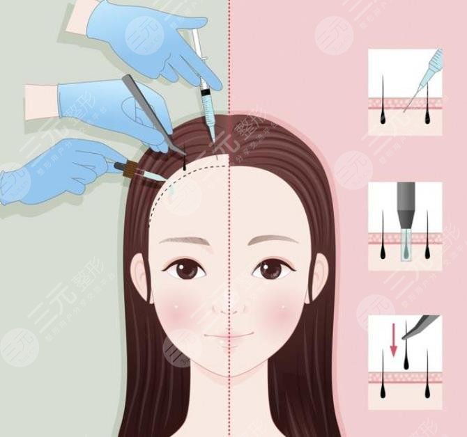 禿頂植發(fā)需要多少錢(qián)