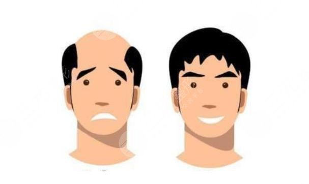 禿頂植發(fā)需要多少錢(qián)