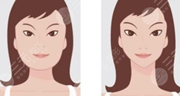 磨骨瘦臉多少費(fèi)用