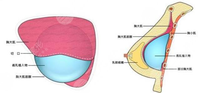 娜綺麗假體隆胸