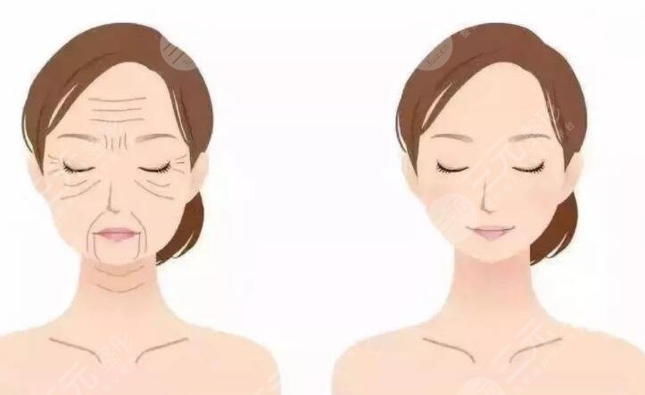 什么是筋膜重整？