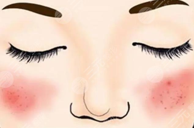 紅血絲激光多少錢(qián)