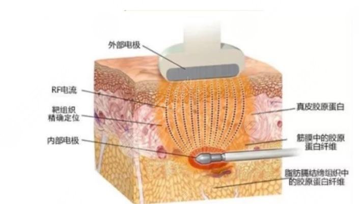 復(fù)合彩光緩解多少錢
