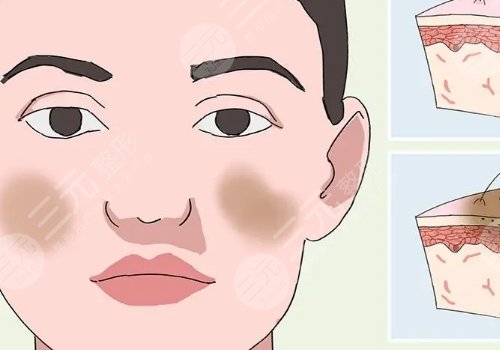 激光祛斑后反黑怎樣能快速消除？