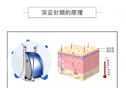 深藍(lán)射頻間隔多久做一次？