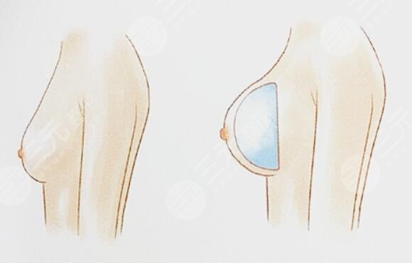 魔滴假體隆胸破裂的情況下會影響健康嗎?