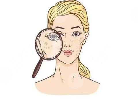 激光祛斑術(shù)后注意事項有哪些?