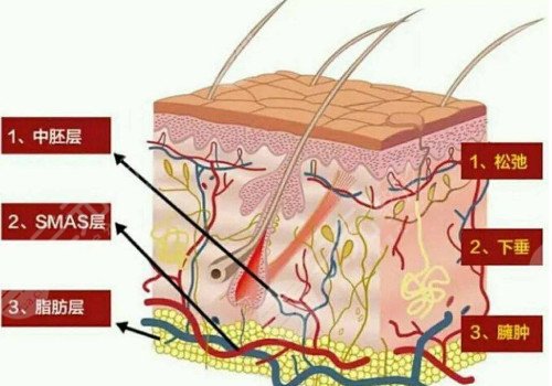 深藍(lán)射頻和熱拉提的區(qū)別