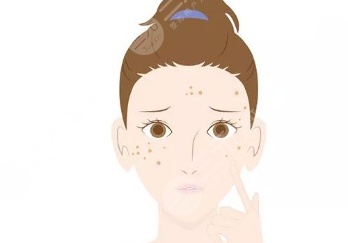 曬斑如何淡化或去掉？