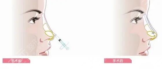 玻尿酸隆鼻可以維持多久時(shí)間?