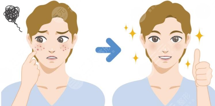 男生祛痘的小竅門是什么?