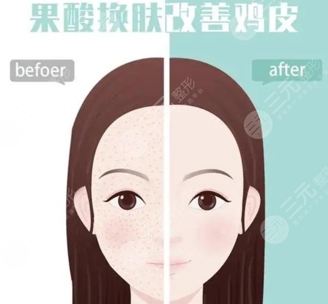 醫(yī)院果酸多少錢一次