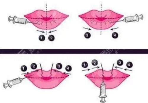 唇部注射玻尿酸多久可以恢復？