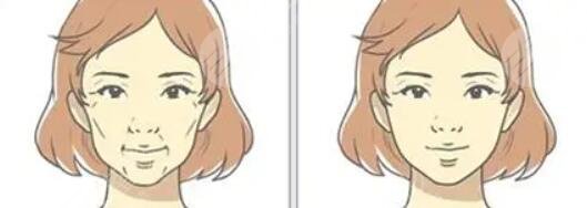 冰電波拉皮除皺的效果怎么樣?