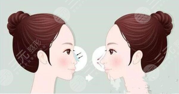 隆鼻假體壽命有多長(zhǎng)?