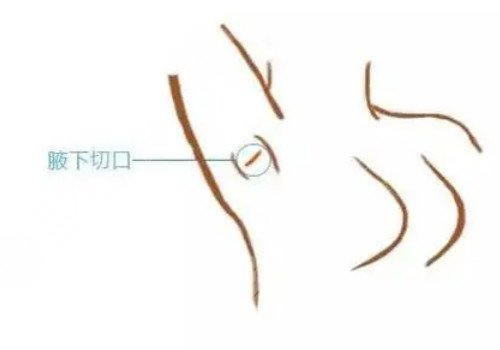 隆胸腋下切口的優(yōu)勢和缺點有哪些？