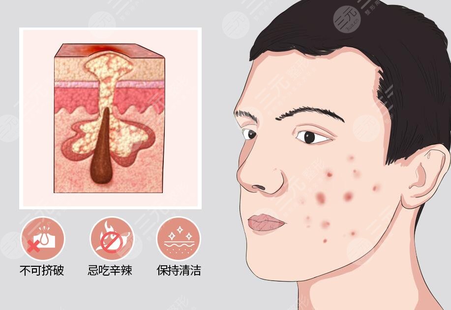 激光去痘印之后應(yīng)該怎樣去護理?