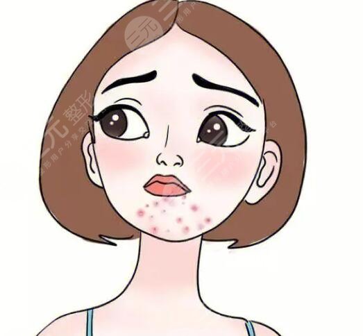 激光磨皮祛痘印有副作用嗎?