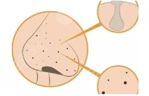 去黑頭有哪些方法?