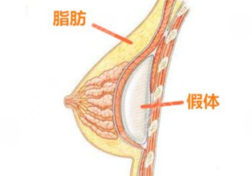 假體豐胸如何避免包膜痙攣？
