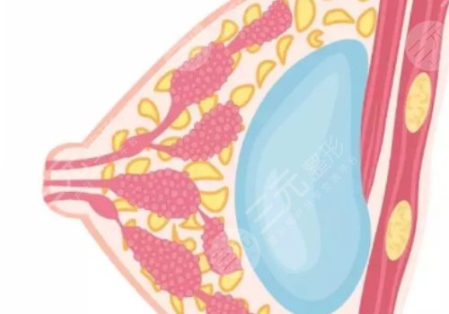 假體豐胸如何避免包膜痙攣？