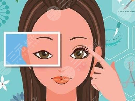 上海割雙眼皮費(fèi)用