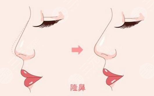 鼻翼整形手術(shù)多少錢(qián)