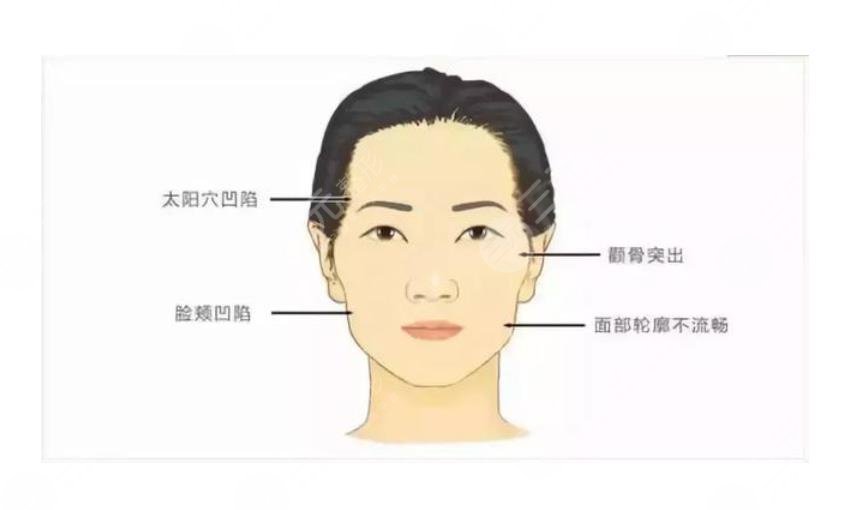 嘟嘟肉吸脂前后照片