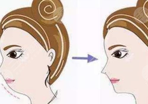 臉部輪廓固定怎么做？
