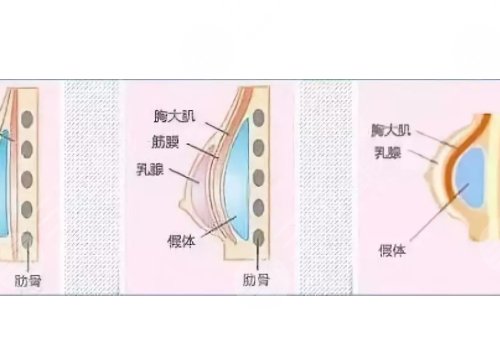 光面假體隆胸后需要怎么樣按摩？
