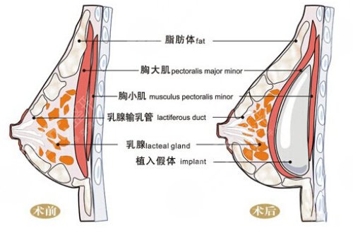 光面假體隆胸后需要怎么樣按摩？