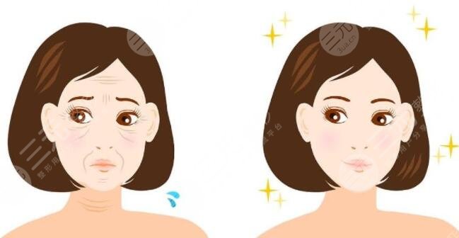 射頻緊膚要做幾次有效果?