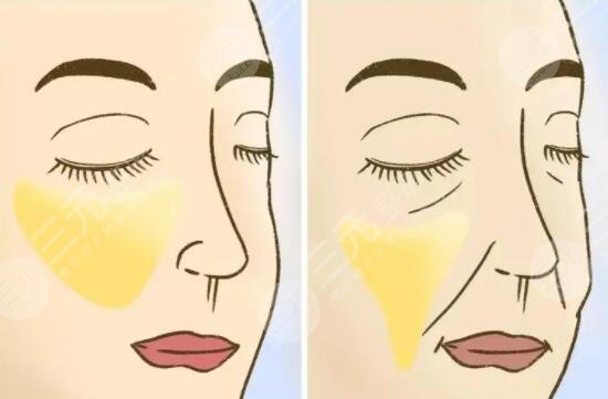 在做了射頻緊膚之后需要注意什么?