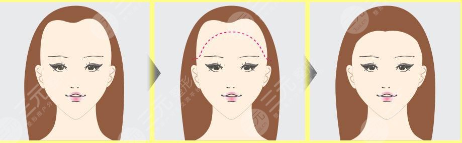 紋發(fā)際線和植發(fā)哪個好？區(qū)別對比分析！術前必看~