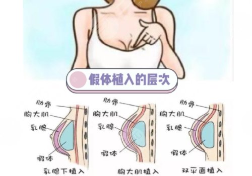 毛面假體和光面假體哪個(gè)好?