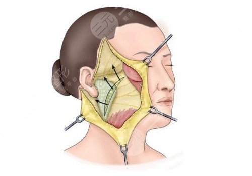 耳前皺紋多如果拉皮術(shù)會(huì)留疤嗎？