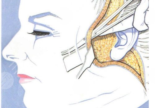 耳前皺紋多如果拉皮術(shù)會(huì)留疤嗎？